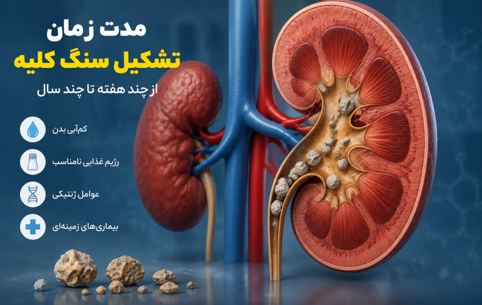 مدت زمان تشکیل سنگ کلیه