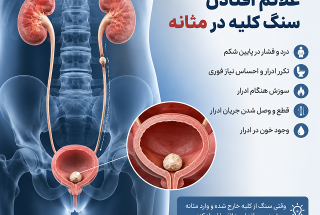 علائم افتادن سنگ کلیه در مثانه