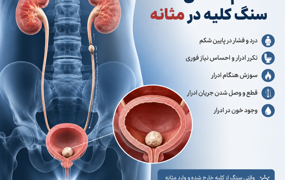 علائم افتادن سنگ کلیه در مثانه